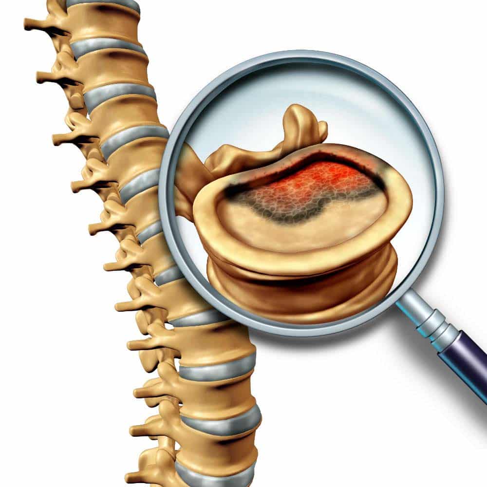 Detalhe de espinha dorsal com câncer na coluna - Site Dr. Márcio Penna - ortopedista especialista em coluna
