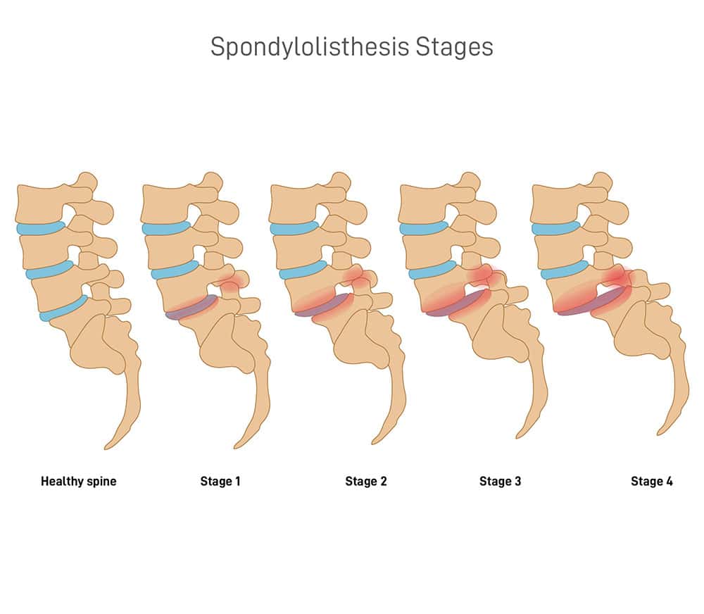 Ilustrações de coluna vertebral demonstrando a espondilolistese - Site Dr. Márcio Penna - ortopedista especialista em coluna