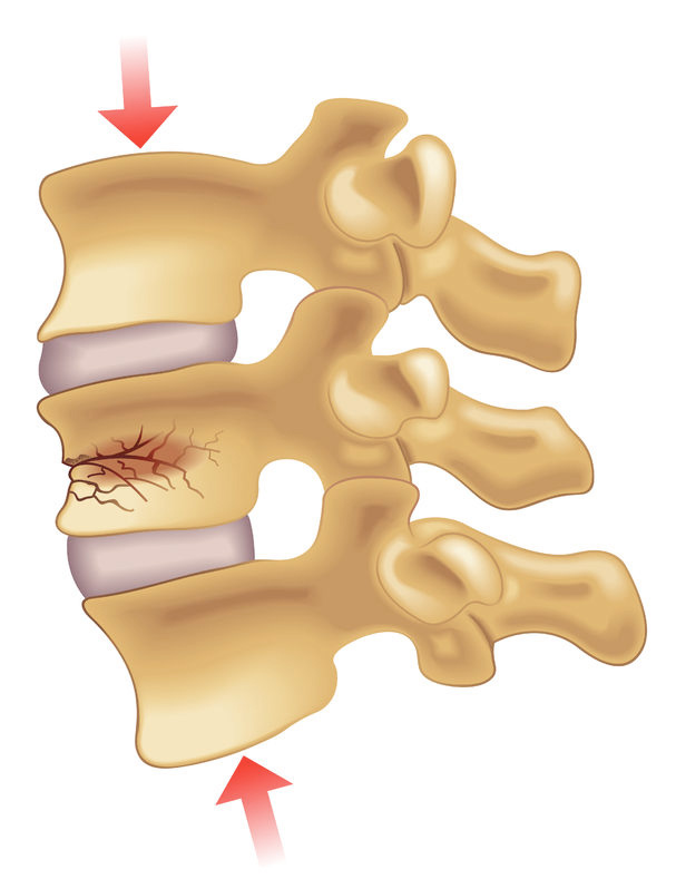 Ilustração mostrando fratura na coluna - Site Dr. Márcio Penna - ortopedista especialista em coluna