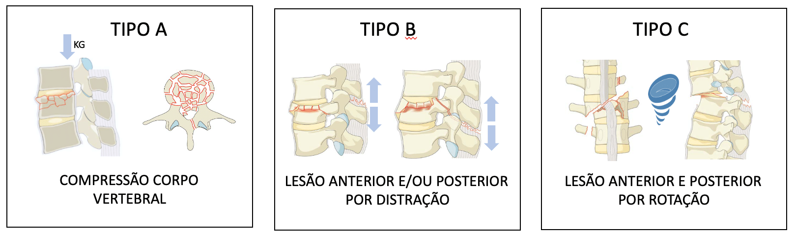 Ilustrações mostrando tipos de fraturas na coluna - Site Dr. Márcio Penna - ortopedista especialista em coluna