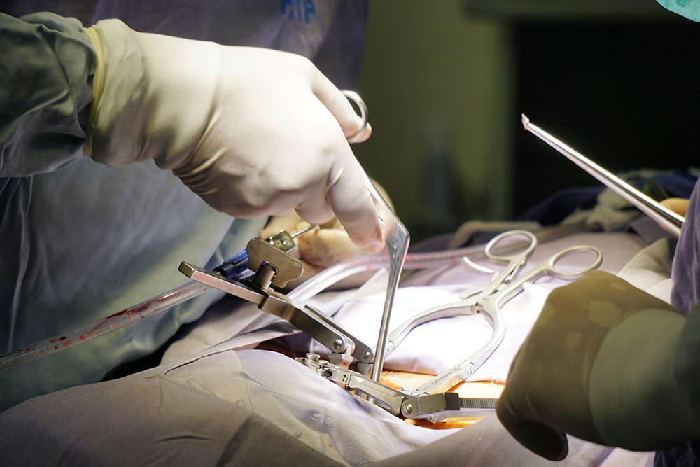 Cirurgia minimamente invasiva de coluna sendo feita - site Dr. Marcio Penna, ortopedista cirurgião de coluna