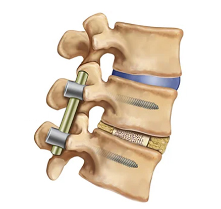 Ilustração mostrando artrodese - Site Dr. Márcio Penna - ortopedista especialista em coluna de Belém - Pará