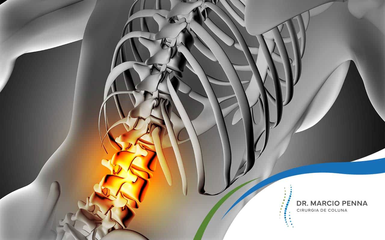 Dores na coluna vertebral - Site Dr. Márcio Penna - ortopedista especialista em coluna de Belém - Pará